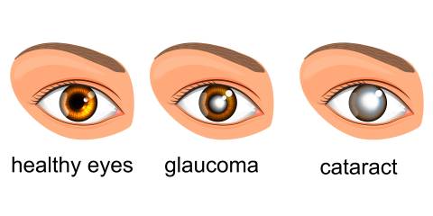 Glaucoma