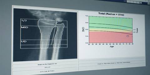 a screen showing bone mass imaging results